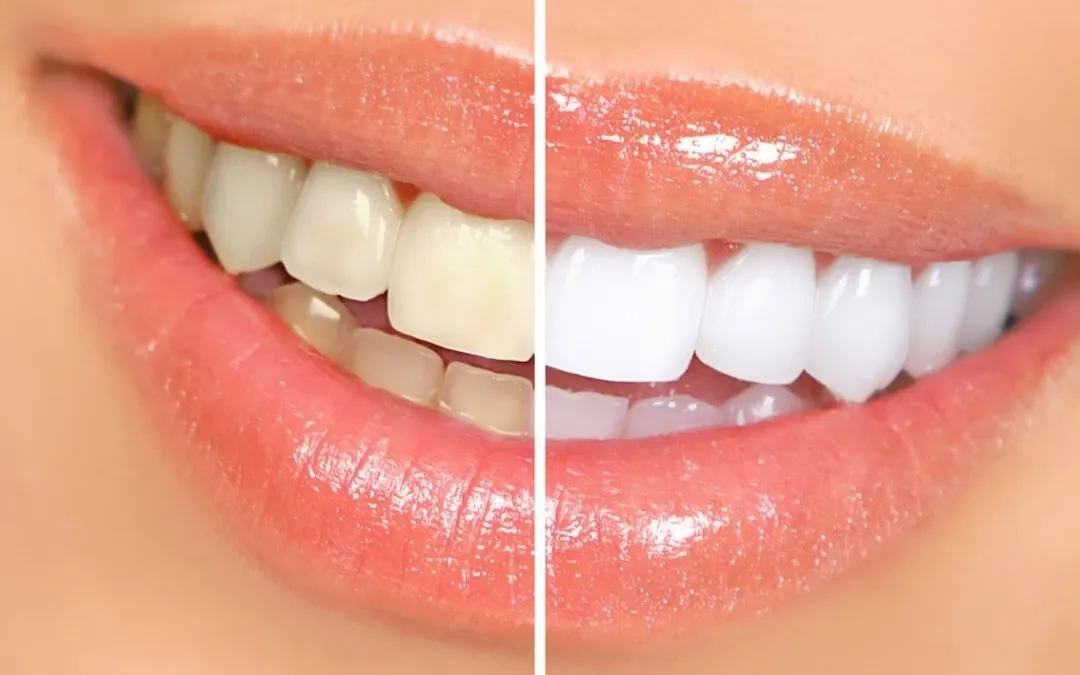 Teeth Whitening