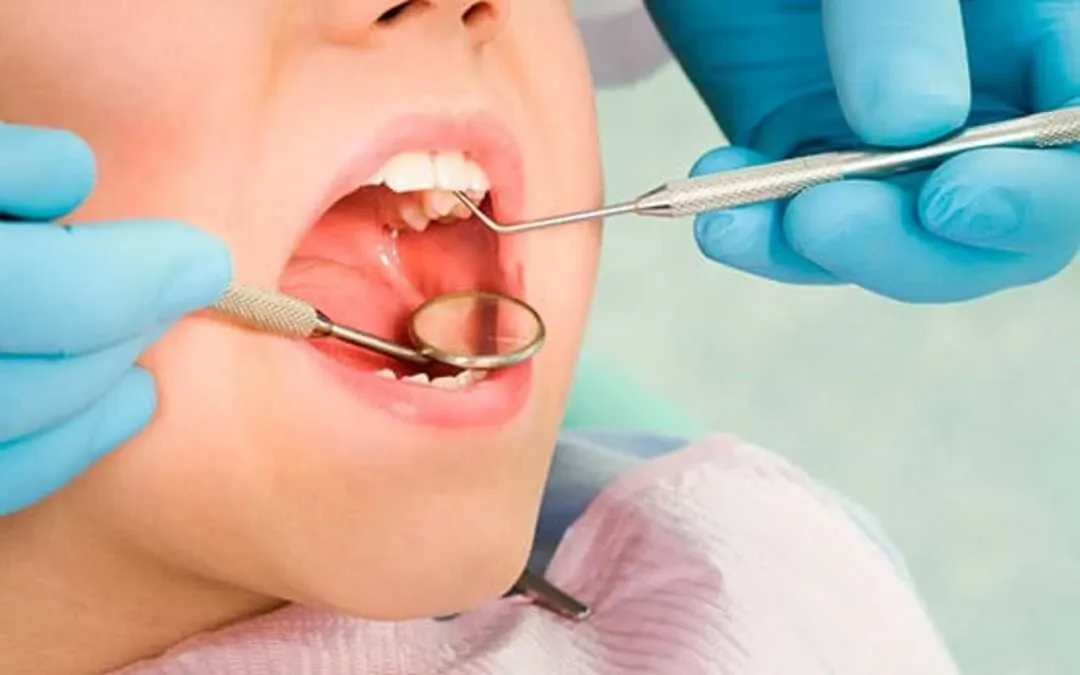 Cavity Fillings