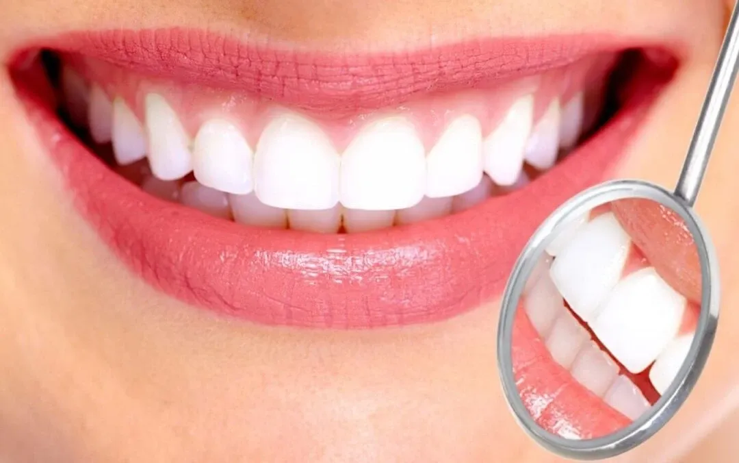 Composite and Porcelain Veneers